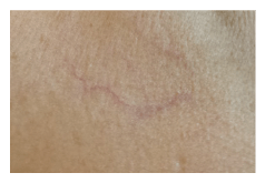 Skin lesions - thread veins