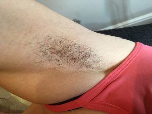 Photo of a womans underarm before treatment with lumenis lightsheer desire laser.