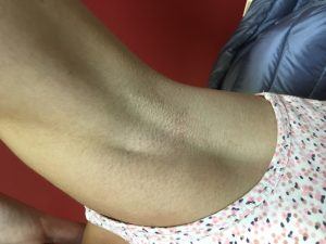 Photo of underarm after laser hair removal using the Lumenis LightSheer desire laser.